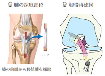 膝靱帯手術の全て